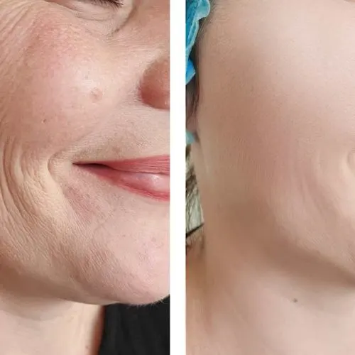 Before and after treatment result