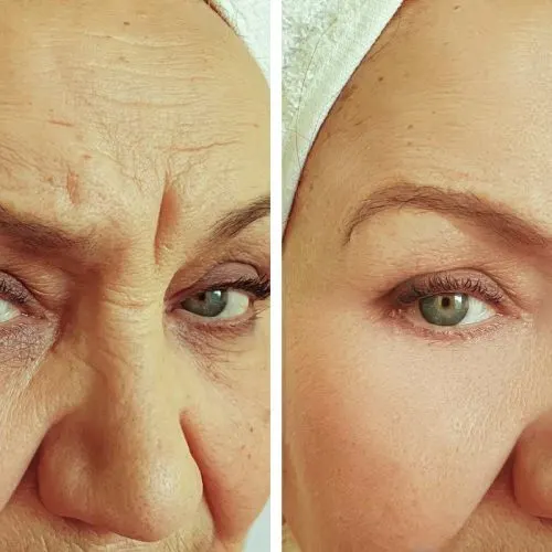 Before and after treatment result