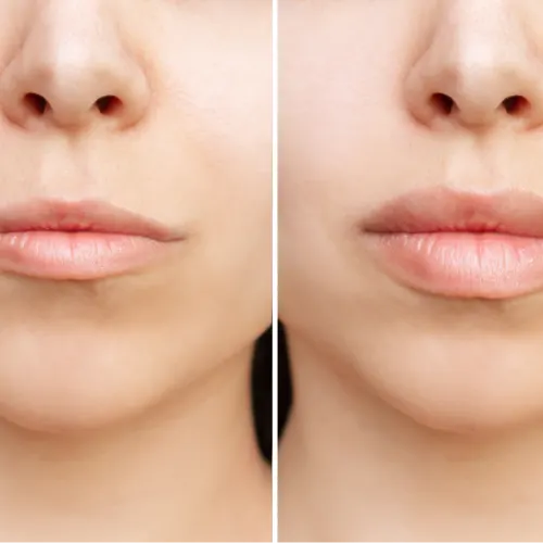 Before and after treatment result
