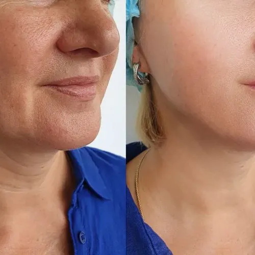 Before and after treatment result