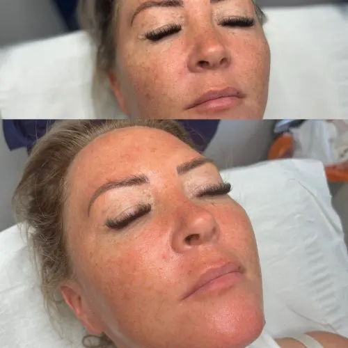 Before and after treatment result