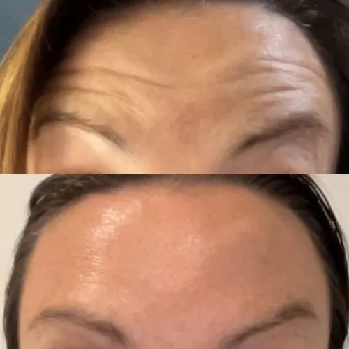 Before and after treatment result