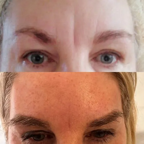 Before and after treatment result