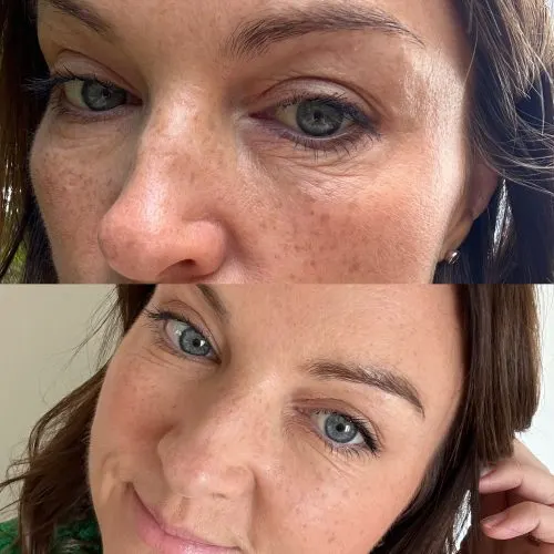 Before and after treatment result