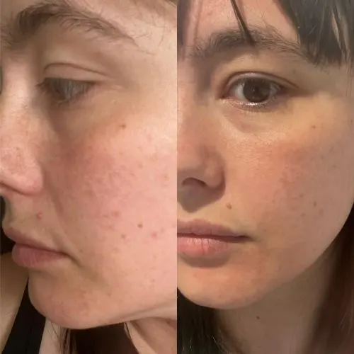 Before and after treatment result