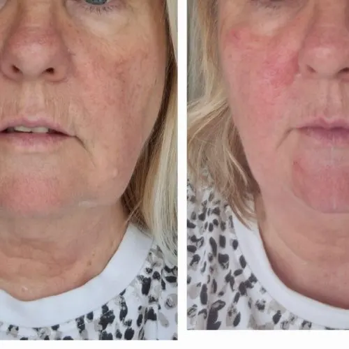Before and after treatment result