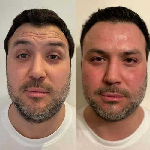 Before and after treatment result
