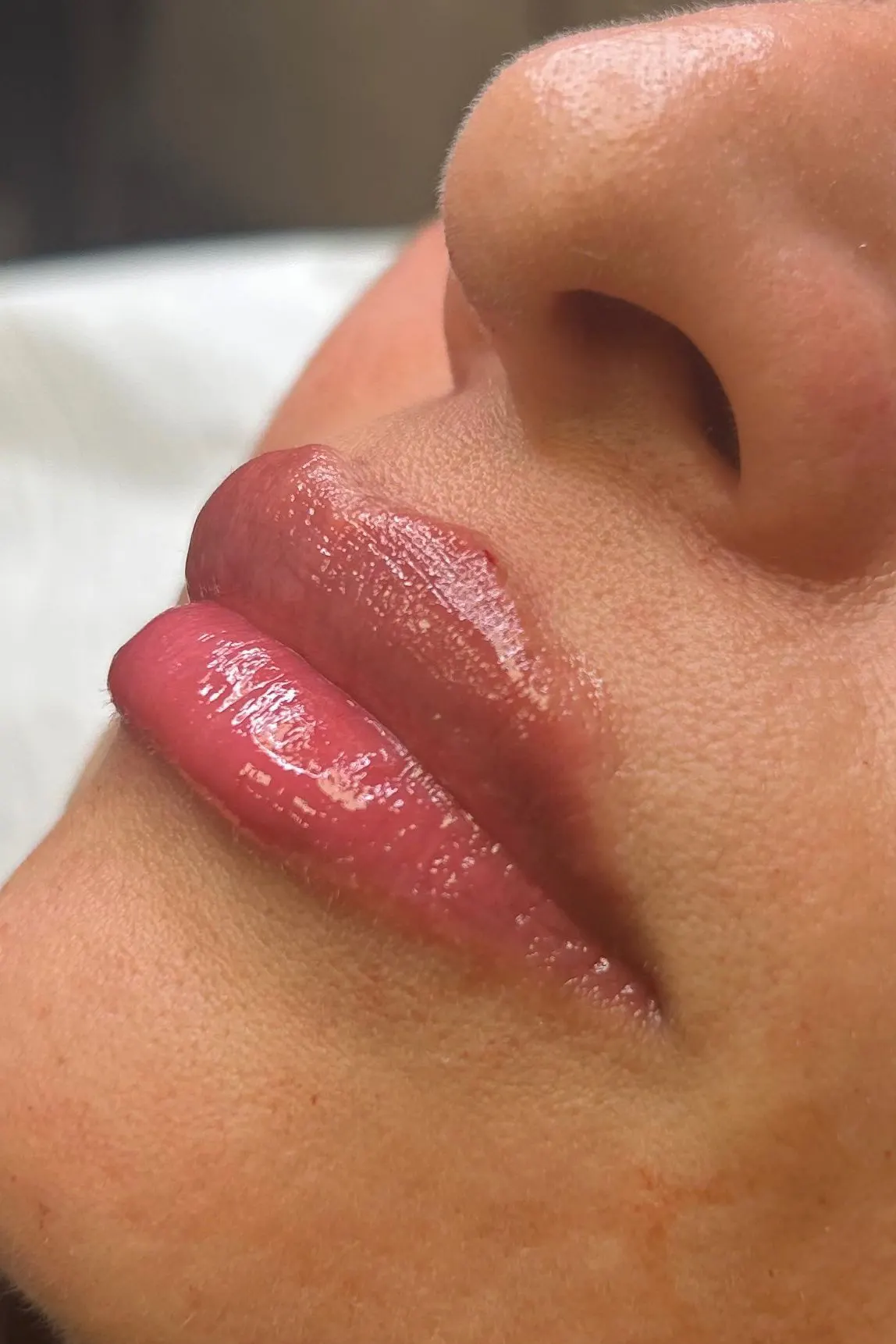 Lip filler Coulsdon