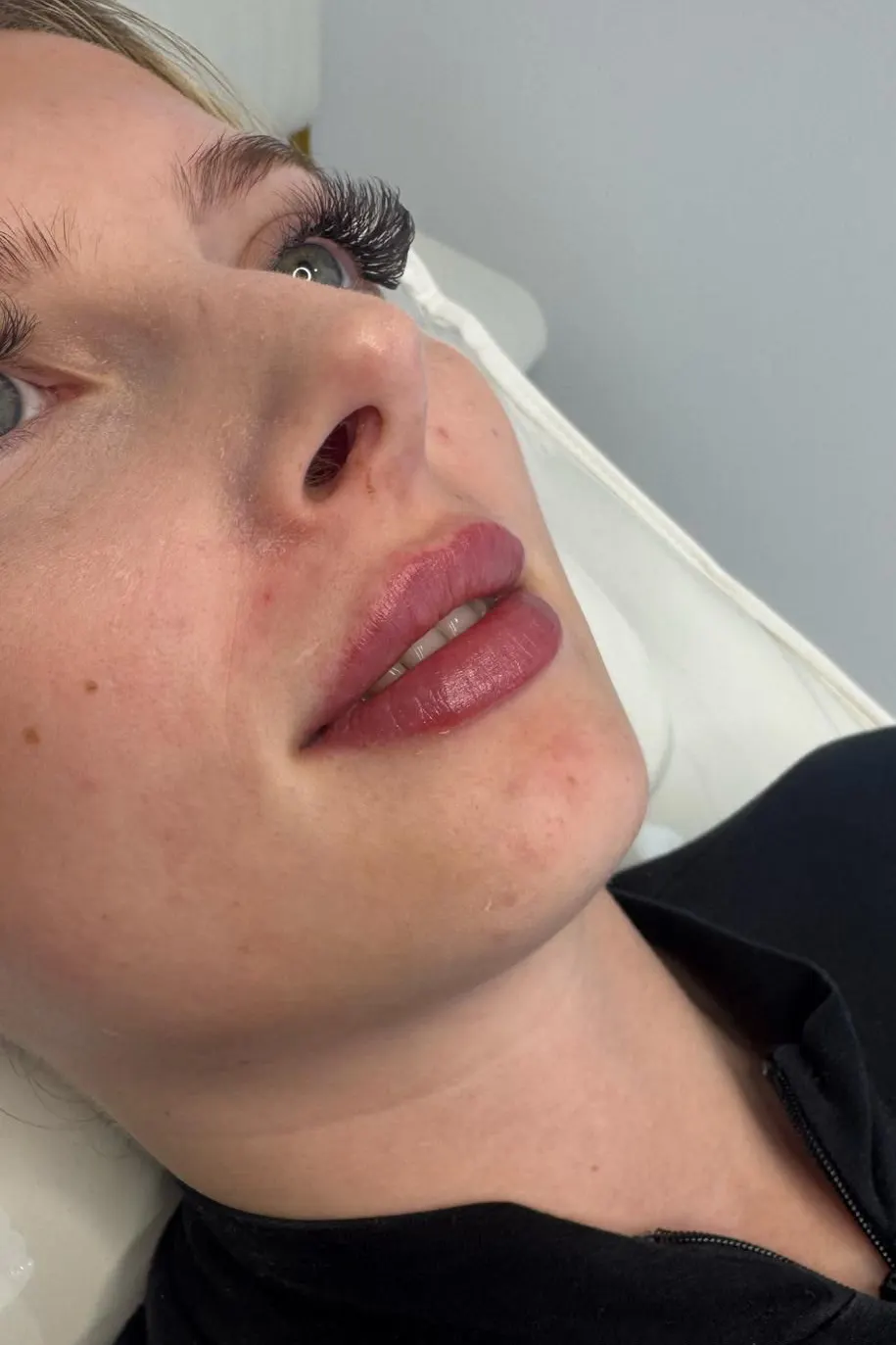Lip Fillers