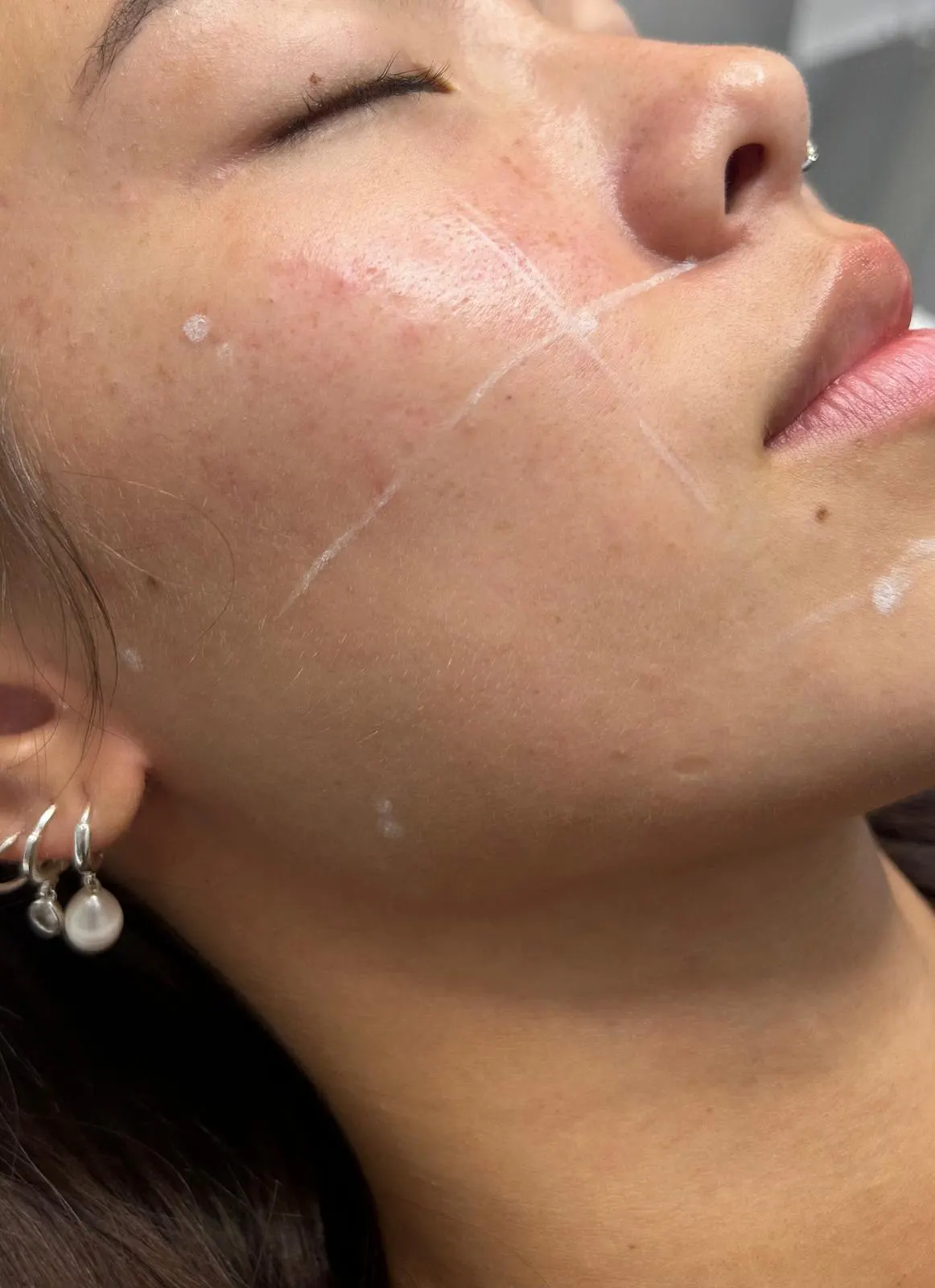 Profhilo treatment