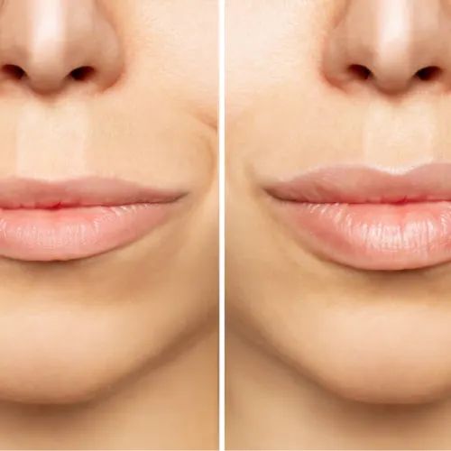 Before and after treatment result