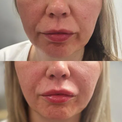 Before and after treatment result