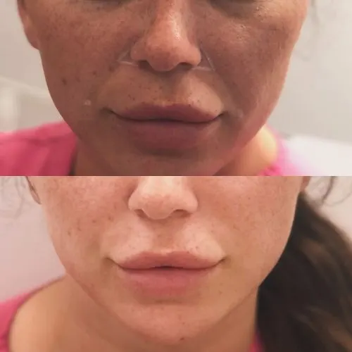 Before and after treatment result