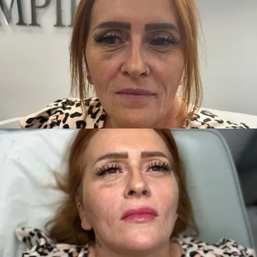 Before and after treatment result